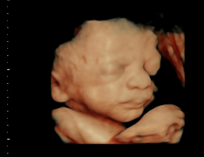 3D ultrasound image at 31 weeks